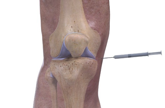 cortisone injection into the knee